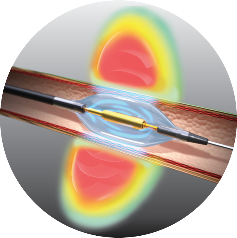 Paradise Ultrasound Renal Denervation