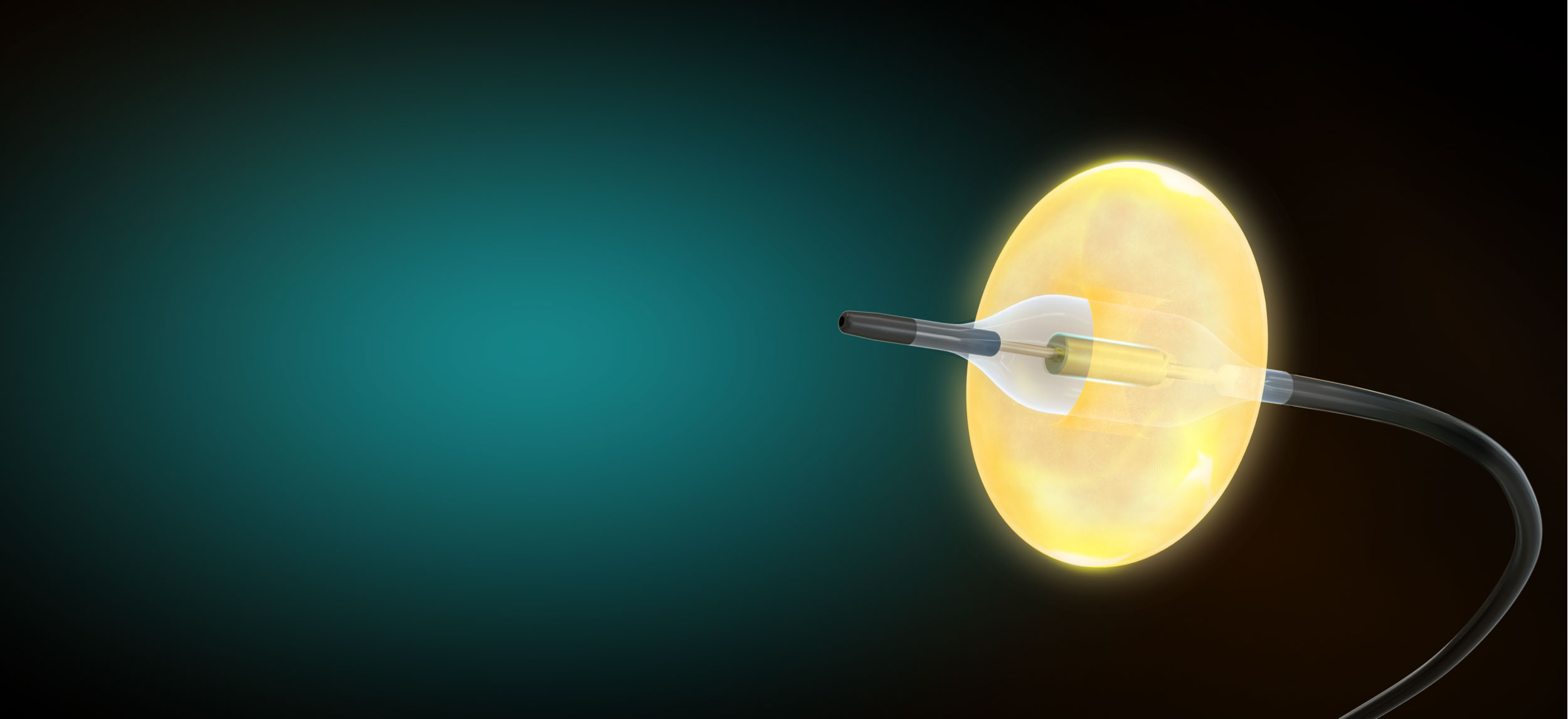 Recor Medical Ultrasound Rendal Denervation
